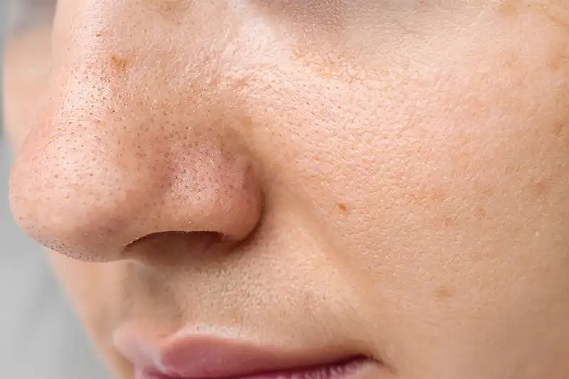 Les Pores Dilatés : Causes, Solutions et Astuces pour une Peau Plus Lisse
