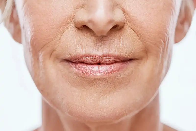 J’ai des rides autour de la bouche : que faire ?