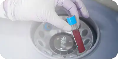 Biostimulation Microneedling PRP