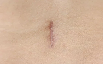 Cicatrices chirurgicales : traitement par laser