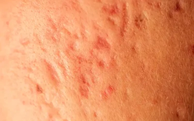 Cicatrices d’acné&nbsp;: traitements efficaces pour lisser la&nbsp;peau