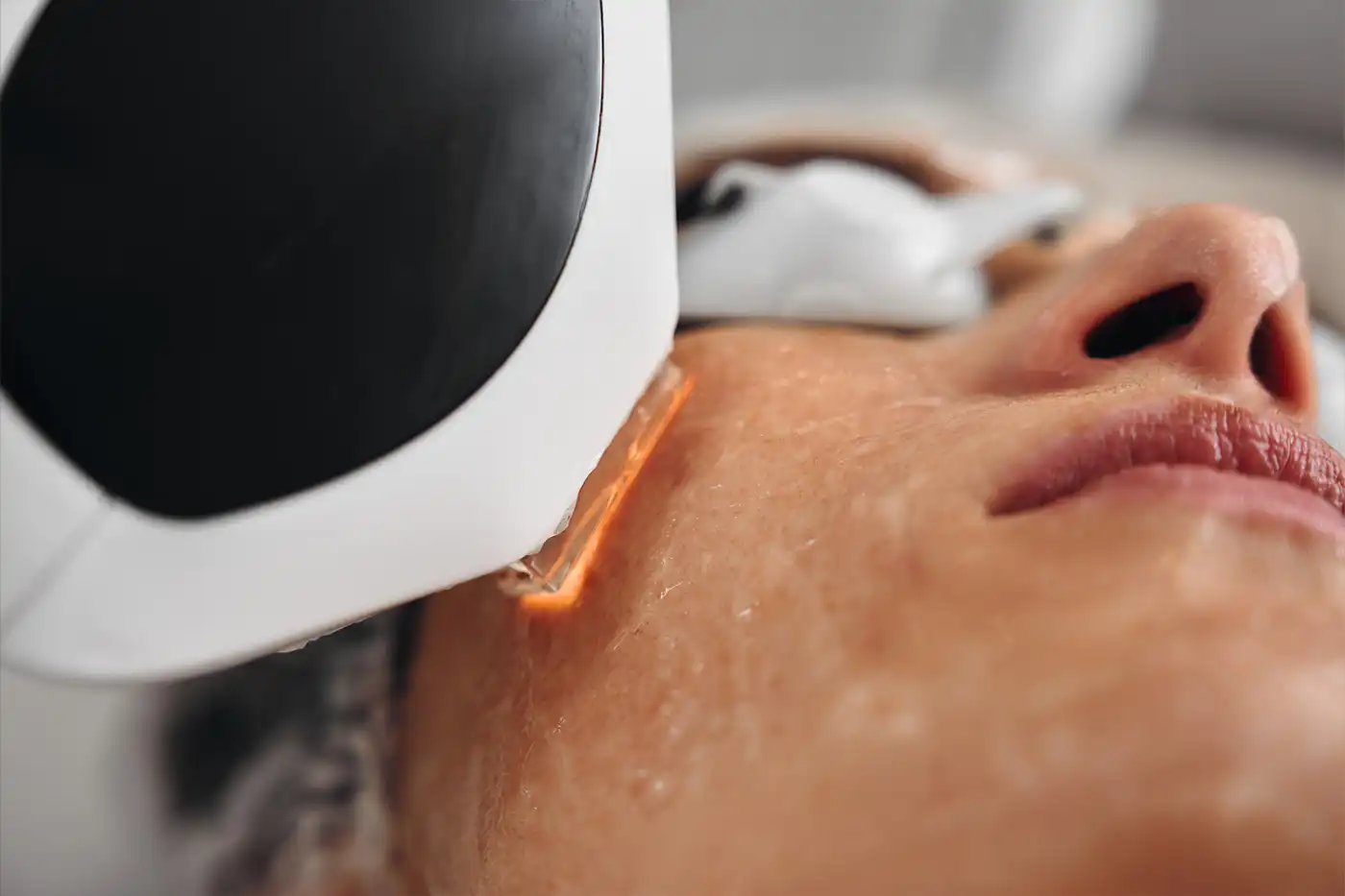 traitement laser IPL taches solaires