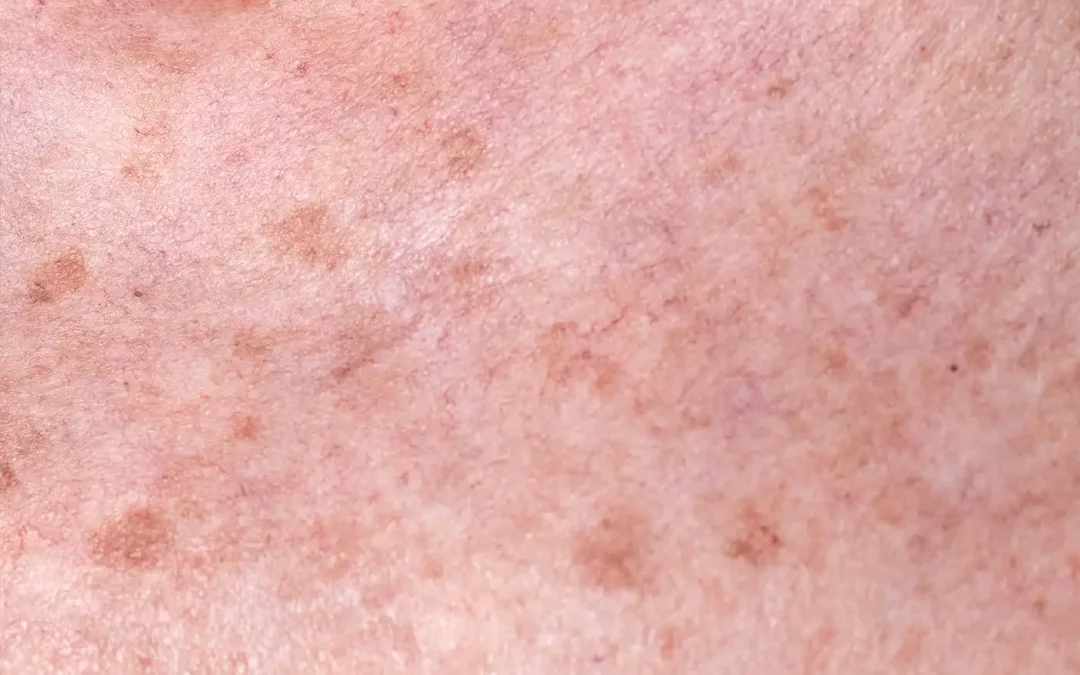IPL – Laser pigmentaire : éliminer les taches&nbsp;solaires efficacement