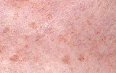 IPL – Laser pigmentaire : éliminer les taches&nbsp;solaires efficacement